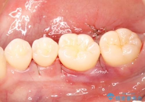侵襲性歯周炎によるシビアな骨欠損　再生治療で回復の治療中