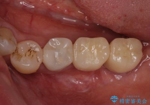 奥歯が抜けそう　部分矯正による咬み合わせの改善とインプラントによる補綴治療