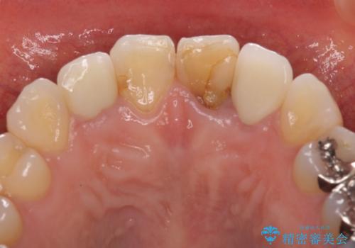 前歯の歯並びと変色を改善　インビザラインとオールセラミックの治療後