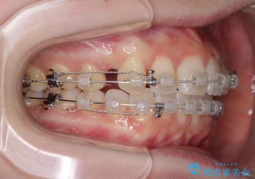 前歯の出っ歯とでこぼこを抜歯矯正で改善　目立たないワイヤー矯正の治療中