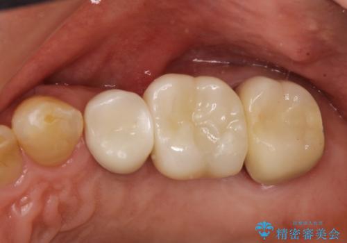 歯根破折により抜歯となってしまった奥歯のインプラントによる咬み合わせ回復の治療後