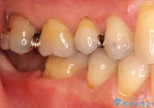 目立つ銀歯を白くしたい　銀歯からセラミックへの再補綴の治療前
