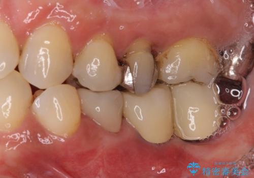 奥歯が抜けそう　部分矯正による咬み合わせの改善とインプラントによる補綴治療の治療後