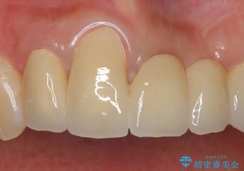 前歯のセラミックブリッジ　長すぎる前歯を部分矯正で修正するの治療前