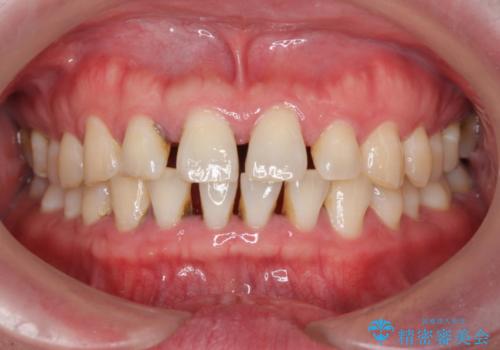 歯の周り、歯肉の中に付着していた歯石を超音波にて除去の治療前