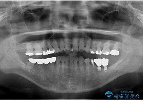 奥歯が抜けそう　部分矯正による咬み合わせの改善とインプラントによる補綴治療の治療後