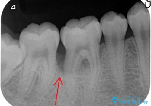 侵襲性歯周炎によるシビアな骨欠損　再生治療で回復の治療前