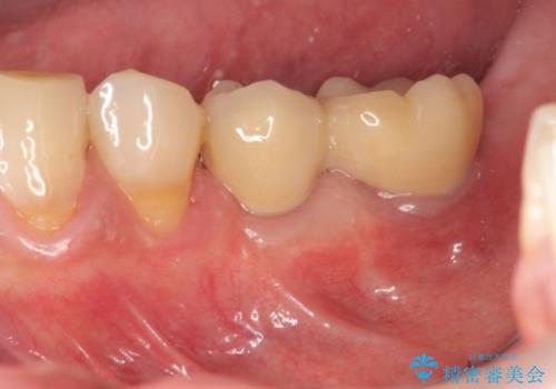 [歯の欠損] インプラントによる咬合回復の治療後