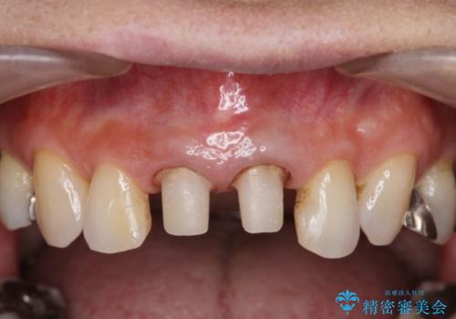 [前歯　オールセラミック治療]  前歯に天然歯のような透明感を創るの治療中
