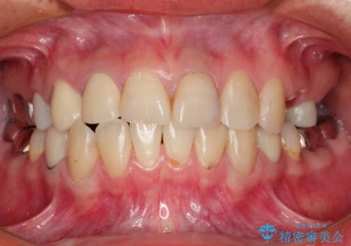 全顎的に多発した虫歯治療の症例 治療前