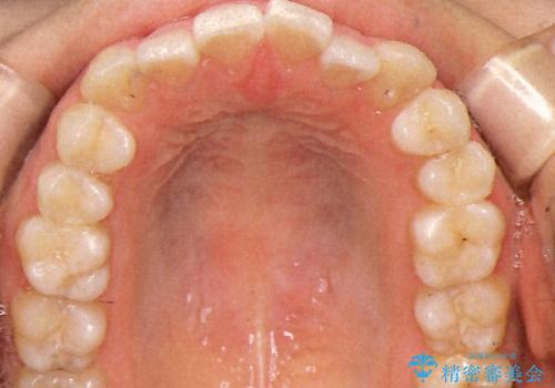 表側のワイヤー矯正　口元の改善をはかる抜歯矯正の治療前