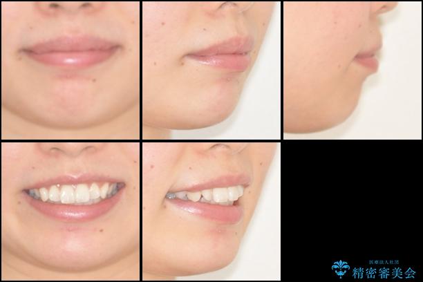 前歯の出っ歯とでこぼこを抜歯矯正で改善　目立たないワイヤー矯正の治療前（顔貌）