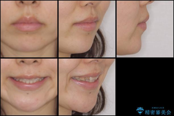 前歯の歯並びと変色を改善　インビザラインとオールセラミックの治療前（顔貌）