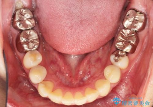 全顎的に多発した虫歯治療の治療前