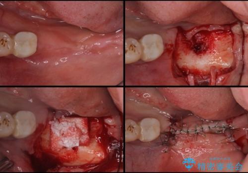 奥歯が抜けそう　部分矯正による咬み合わせの改善とインプラントによる補綴治療の治療中