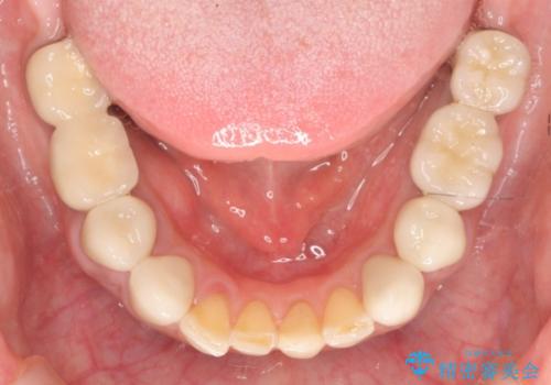 下顎大臼歯欠損　インプラントによる咬合機能回復の治療後