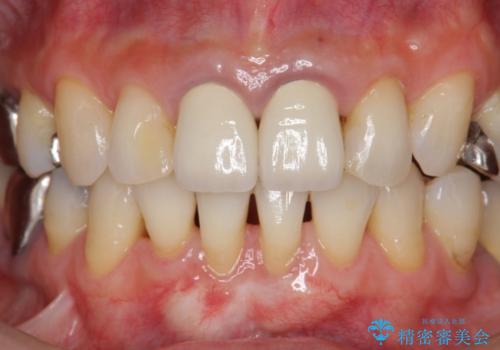 [前歯　オールセラミック治療]  前歯に天然歯のような透明感を創るの治療前