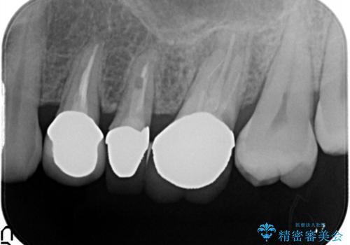 奥歯の被せものの治療前
