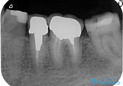 奥歯の被せものの治療前