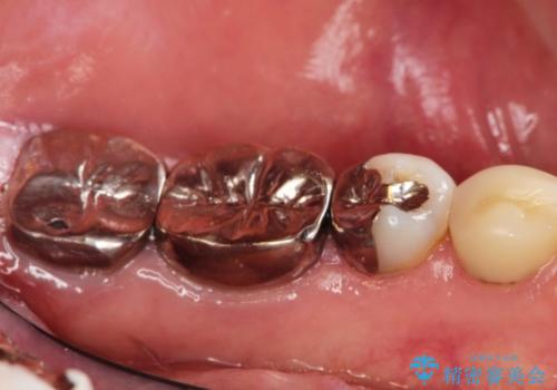 全顎的に多発した虫歯治療の治療前