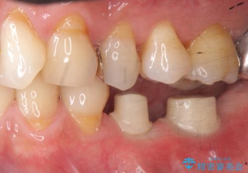 [歯の欠損] インプラントによる咬合回復の治療中