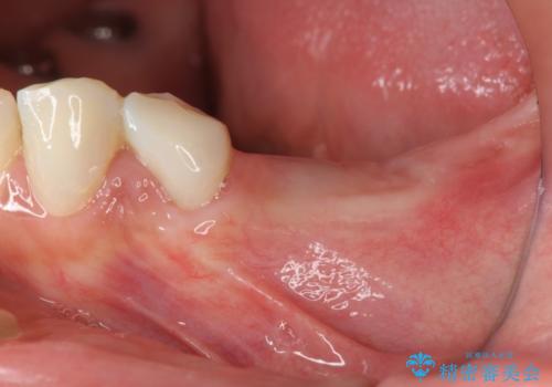 下顎大臼歯欠損　インプラントによる咬合機能回復の治療前