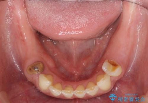 下顎大臼歯欠損　インプラントによる咬合機能回復の治療前