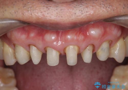 不自然なセラミックが気になる　オールセラミックジルコニアクラウンによる前歯審美治療の治療中