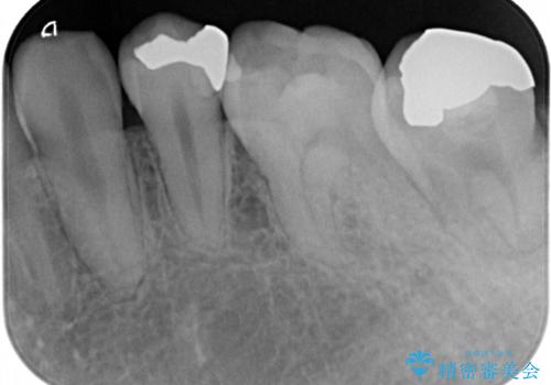 小さい虫歯　歯にやさしいゴールドインレーの治療後