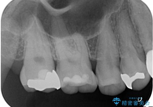 セラミックインレー 天然の歯に近い透明感や色調を再現するの治療前