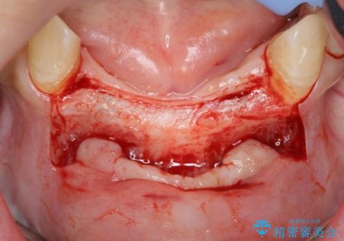 骨造成を伴う下顎前歯インプラントの治療中