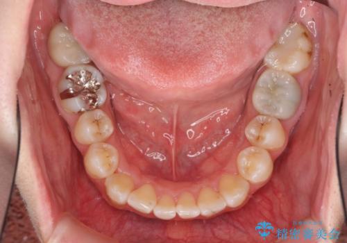 歯のガタガタをマウスピース矯正で治療の治療中