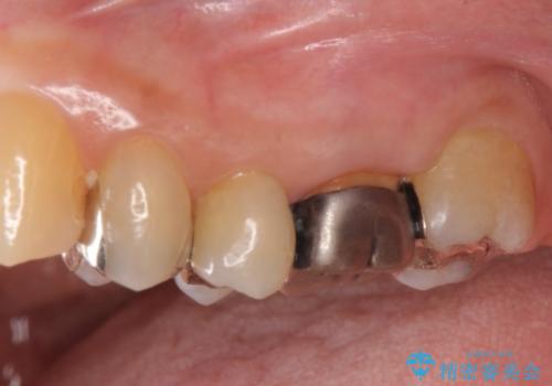 [噛むと痛い]残すことができない歯のオールセラミックブリッジ治療の治療前