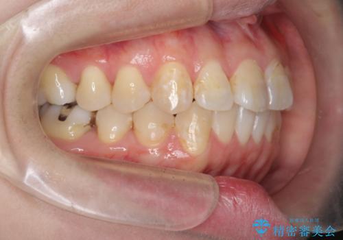 歯のガタガタをマウスピース矯正で治療の治療後