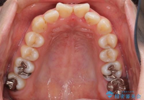 歯のガタガタをマウスピース矯正で治療の治療前