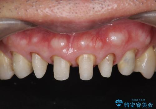 不自然なセラミックが気になる　オールセラミックジルコニアクラウンによる前歯審美治療の治療中