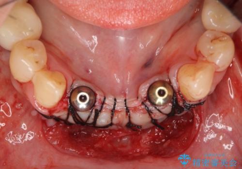 骨造成を伴う下顎前歯インプラントの治療中