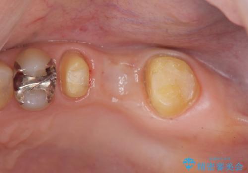 [噛むと痛い]残すことができない歯のオールセラミックブリッジ治療の治療中