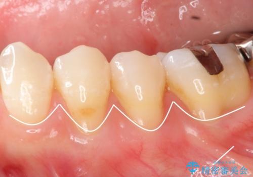 矯正治療後の歯肉退縮　歯肉移植による根面被覆の治療前