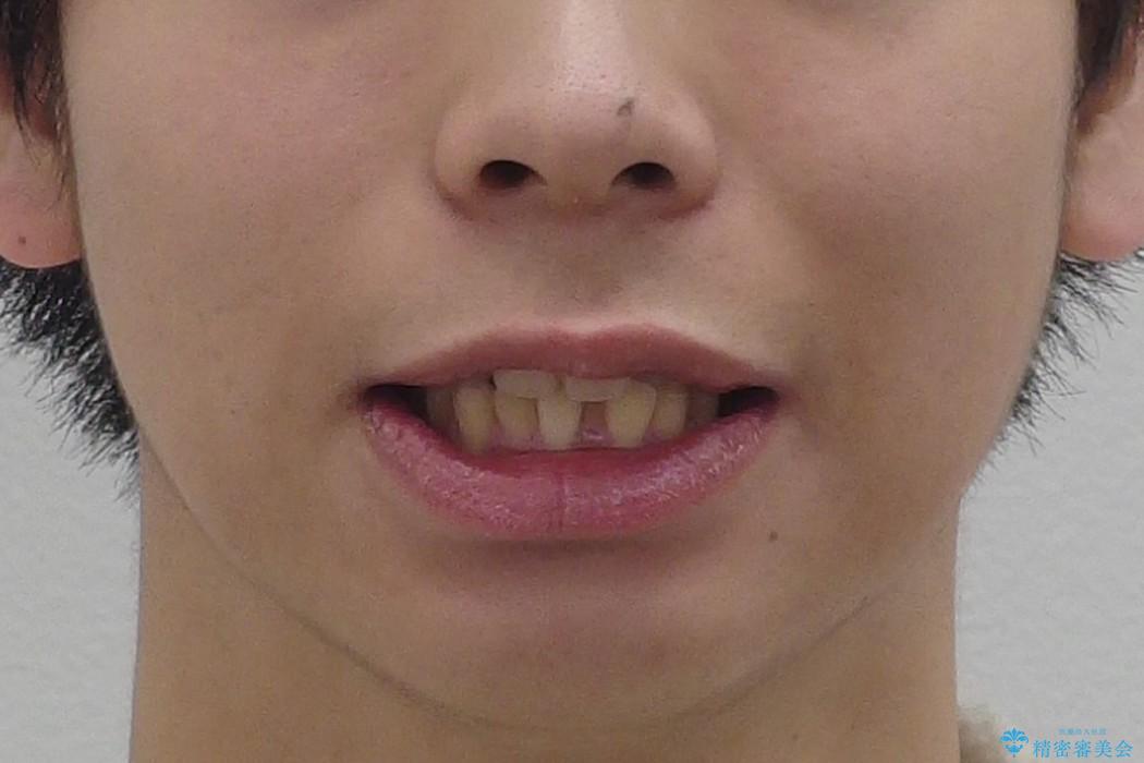 前歯のねじれ　下の歯のガタガタの治療前（顔貌）