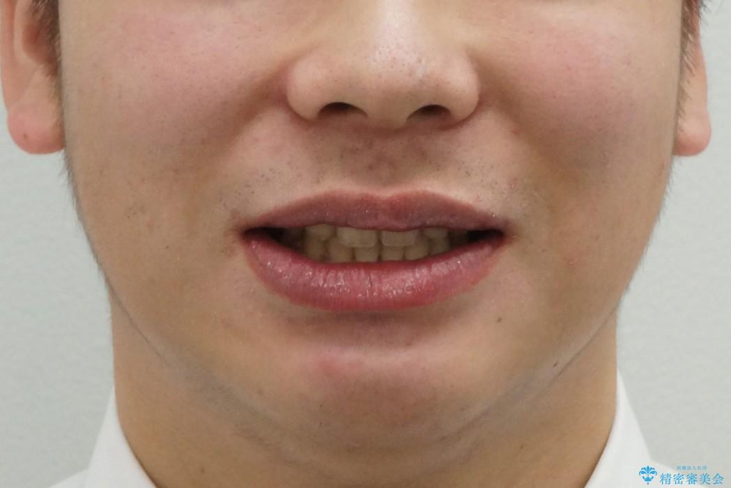 前歯のねじれ　下の歯のガタガタの治療後（顔貌）