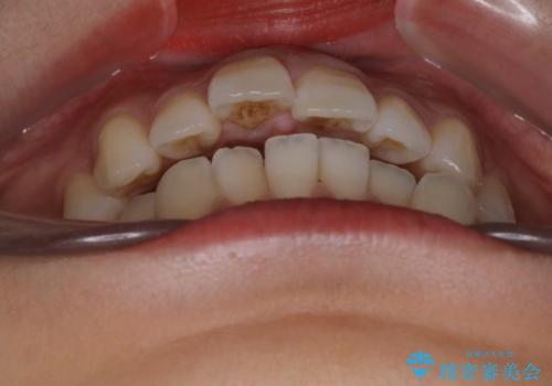 インビザラインで前歯のガタガタを改善の治療前