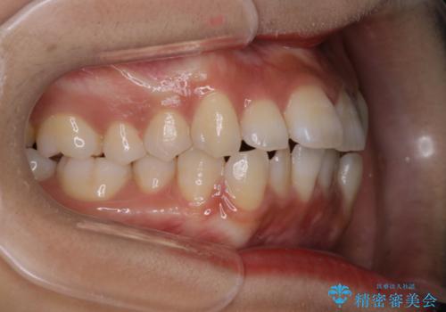 インビザラインで前歯のガタガタを改善の治療前