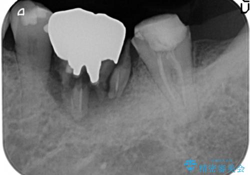 歯が割れた　ブリッジによる咬合機能回復の治療前