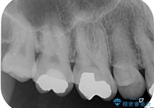 金属の詰め物の下に虫歯が　オールセラミッククラウンによる虫歯治療の治療前