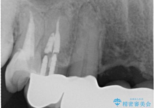 前歯のブリッジの再製作　根管治療からやり直すの治療後
