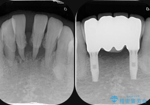 骨造成を伴う下顎前歯インプラント