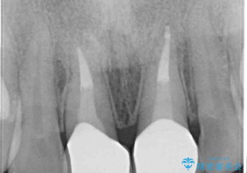 短い前歯を長くしたい　外科処置を用いた前歯のセラミック治療の治療後