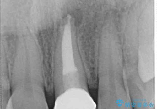 歯肉のラインが汚れている前歯　セラミックによる審美治療の治療後