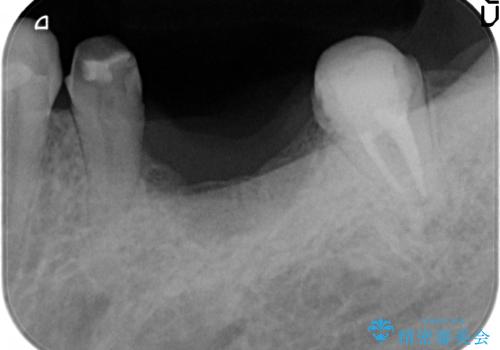 歯が割れた　ブリッジによる咬合機能回復の治療中